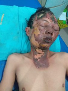 Iqbal Kritis Usai Tersengat Kabel Listrik, Kantor Advokad Firmansyah Layangkan Somasi ke PLN UP3 Jambi